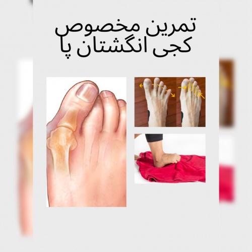 بهترین تمرینات مخصوص کجی انگشت شصت پا | درمان قطعی در خانه