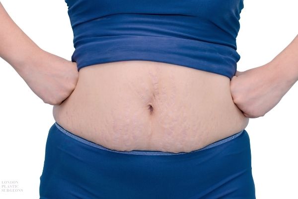 جراحی لیفت شکم یا ابدومینوپلاستی